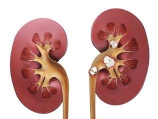 The stones in the kidneys