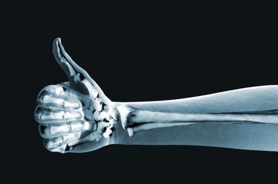 X-rays can help diagnose finger joint pain