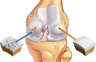 causes of osteoarthritis of the knee joint